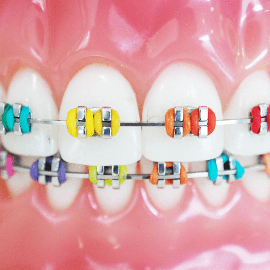 Toms River Teens' Guide to Affordable Braces: Style, Comfort, and Confidence - MyOrthodontist - toms river,affordable braces toms river braces